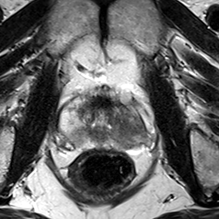 Peripheral-zone lesion, mid-gland (Case 103) T2 axial source preview