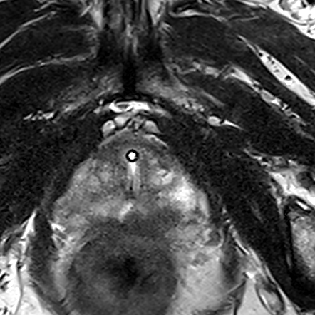 Peripheral-zone lesion, apex (Case 132) T2 axial source preview