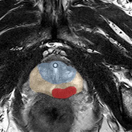 Peripheral-zone lesion, apex (Case 132) MRI preview