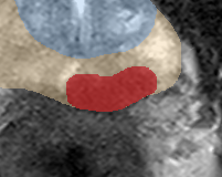 Peripheral-zone lesion, apex (Case 132) lesion zoom preview