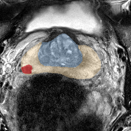 Peripheral-zone lesion, base (Case 29) MRI preview