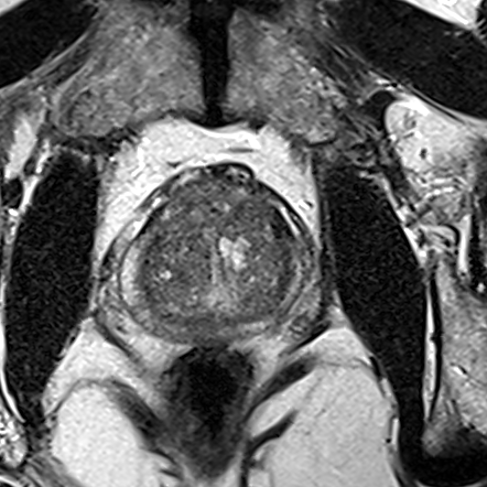 Normal gland anatomy, no lesion (Case 108) T2 axial source preview