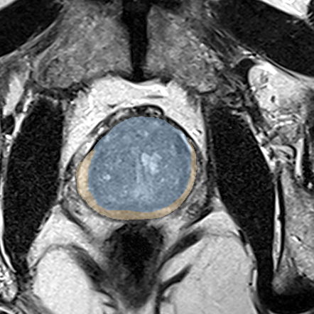 Normal gland anatomy, no lesion (Case 108) MRI preview