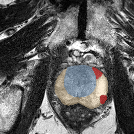 Peripheral-zone lesion, apex (Case 75) MRI preview