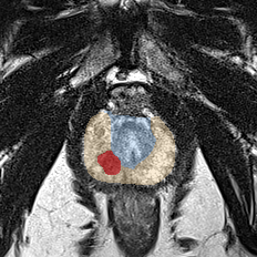Peripheral-zone lesion, apex (Case 35) MRI preview