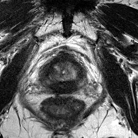 Peripheral-zone lesion, mid-gland (Case 45) T2 axial source preview