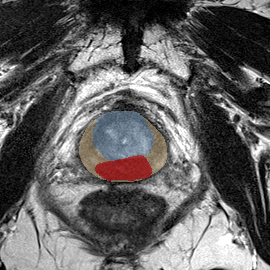 Peripheral-zone lesion, mid-gland (Case 45) MRI preview