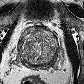 Transition-zone lesion, base (Case 73) T2 axial source preview