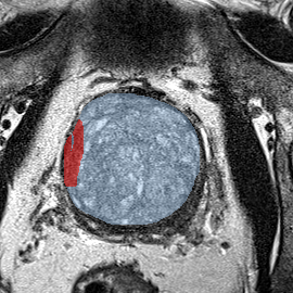 Transition-zone lesion, base (Case 73) MRI preview