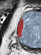 Transition-zone lesion, base (Case 73) lesion zoom preview
