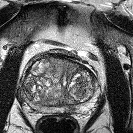 Peripheral-zone lesion, apex (Case 121) T2 axial source preview