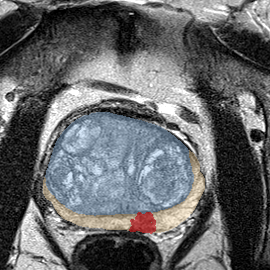 Peripheral-zone lesion, apex (Case 121) MRI preview