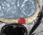 Peripheral-zone lesion, apex (Case 121) lesion zoom preview