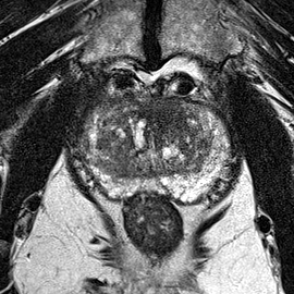 Transition-zone lesion, apex (Case 146) T2 axial source preview