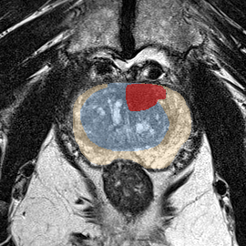 Transition-zone lesion, apex (Case 146) MRI preview