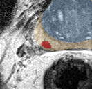 Peripheral-zone lesion, base (Case 118) lesion zoom preview