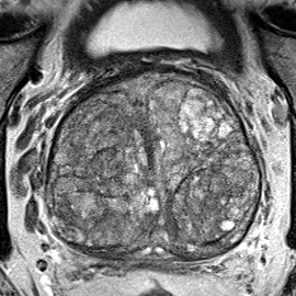 Normal gland anatomy, no lesion (Case 141) T2 axial source preview