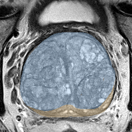 Normal gland anatomy, no lesion (Case 141) MRI preview