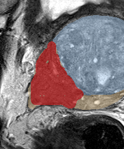 Peripheral-zone lesion, mid-gland (Case 59) lesion zoom preview
