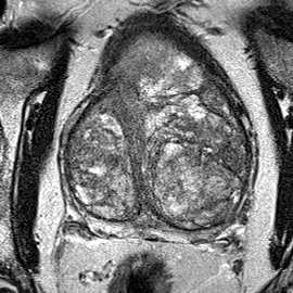 Normal gland anatomy, no lesion (Case 34) T2 axial source preview