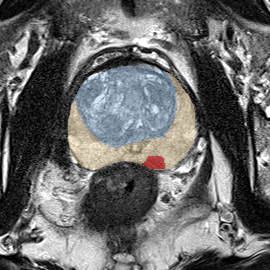Peripheral-zone lesion, mid-gland (Case 96) MRI preview