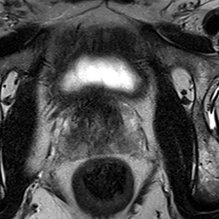 Normal gland anatomy, no lesion (Case 26) T2 axial source preview