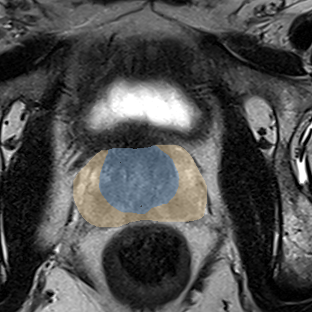 Normal gland anatomy, no lesion (Case 26) MRI preview