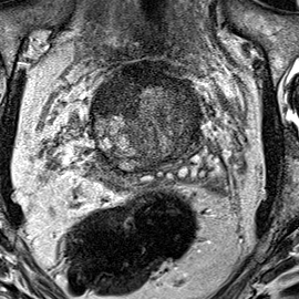 Transition-zone lesion, anterior (Case 25) T2 axial source preview