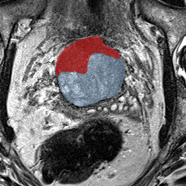 Transition-zone lesion, anterior (Case 25) MRI preview