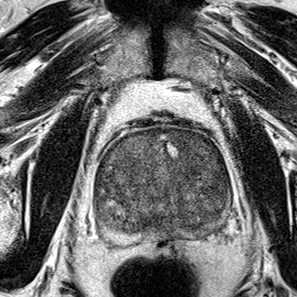 BPH-pattern gland, no lesion (Case 22) T2 axial source preview