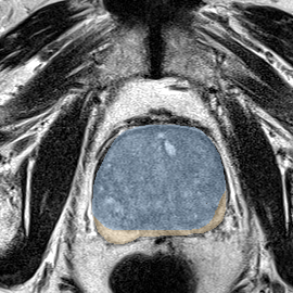 BPH-pattern gland, no lesion (Case 22) MRI preview