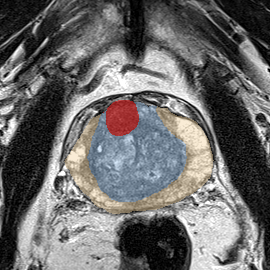 Transition-zone lesion, mid-gland (Case 25) MRI preview