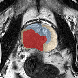 Peripheral-zone lesion, apex (Case 27) MRI preview