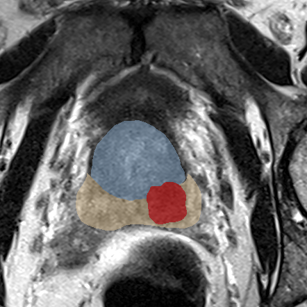 Peripheral-zone lesion, base (Case 28) MRI preview