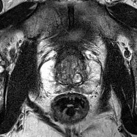 Normal gland anatomy, no lesion (Case 29) T2 axial source preview