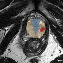 Peripheral-zone lesion, apex (Case 31) MRI preview
