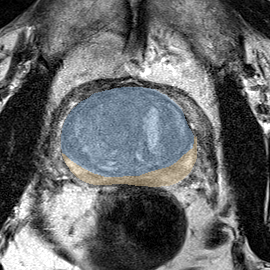 Normal gland anatomy, no lesion (Case 32) MRI preview