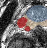 Peripheral-zone lesion, base (Case 33) lesion zoom preview
