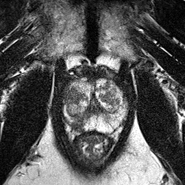 Peripheral-zone lesion, apex (Case 34) T2 axial source preview