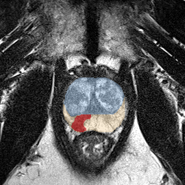 Peripheral-zone lesion, apex (Case 34) MRI preview