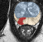 Peripheral-zone lesion, apex (Case 34) lesion zoom preview