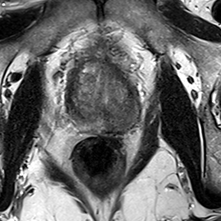 Peripheral-zone lesion, mid-gland (Case 35) T2 axial source preview