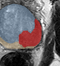 Peripheral-zone lesion, mid-gland (Case 35) lesion zoom preview