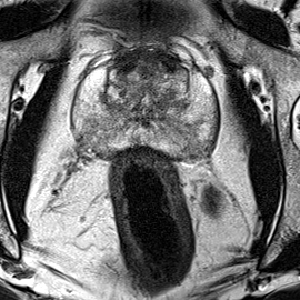 Normal gland anatomy, no lesion (Case 36) T2 axial source preview