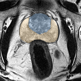 Normal gland anatomy, no lesion (Case 36) MRI preview