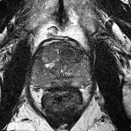 Transition-zone lesion, apex (Case 37) T2 axial source preview