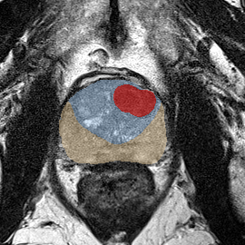 Transition-zone lesion, apex (Case 37) MRI preview