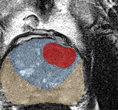 Transition-zone lesion, apex (Case 37) lesion zoom preview