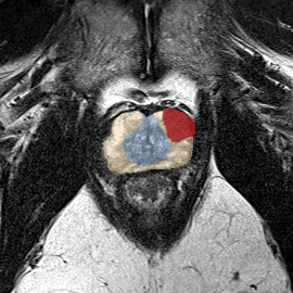 Peripheral-zone lesion, apex (Case 38) MRI preview