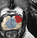 Peripheral-zone lesion, apex (Case 38) lesion zoom preview